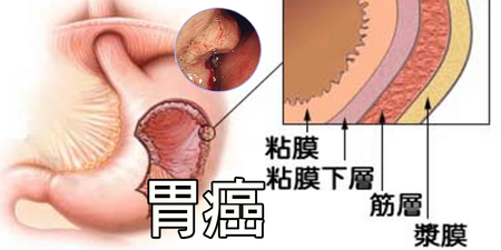 年奪30萬人命！「胃癌」全是吃出來的，「五大養胃食物」散滯血、固胃壁，不分男女老幼必須吃！