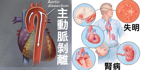 一壓五處傷！近三倍「冠心病」風險，「高血壓」壓出大動脈的「剝離心」！｜每日健康Health