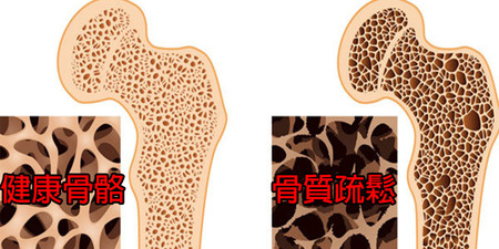 「女性」每3人便有1人「骨質疏鬆」，靠這五招強健骨骼，別讓骨頭一摔就斷｜每日健康Health