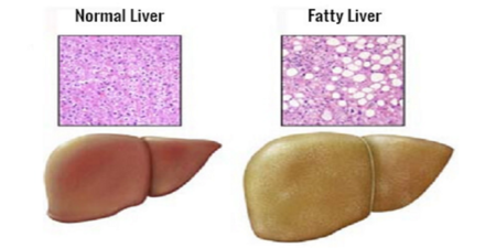 每3人中就有1人脂肪肝，嚴重者可造成「肝癌」！想逆轉病情，這樣吃是最重要的！