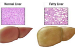 每3人中就有1人脂肪肝，嚴重者可造成「肝癌」！想逆轉病情，這樣吃是最重要的！