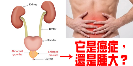 「排尿刺痛」是前列腺「肥大」還是「癌」？50歲男性三人就一人有「前列腺癌細胞」！｜每日健康 Health