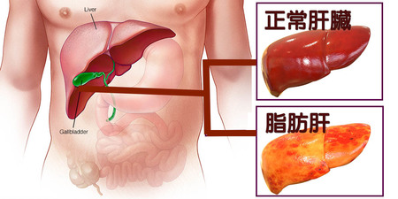 你的肝包「油」了嗎？別讓「脂肪肝」為「肝癌」敞開大門！一出現「5徵兆」速就醫｜每日健康Health