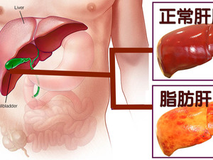 你的肝包「油」了嗎？別讓「脂肪肝」為「肝癌」敞開大門！一出現「5徵兆」速就醫｜每日健康Health