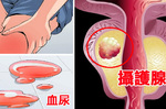 癌症死因第6位—「攝護腺癌」會遺傳！「4大風險因素」男人一定要注意｜每日健康Health