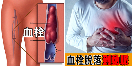 「51%」死亡與「血栓」有關！「防堵四訊號」搶先救，「三動三不動」原則必遵守！｜每日健康Health