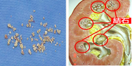 炎夏注意報！超過２７度「腎結石」罹患機率２倍，嚴防「脫水」護腎臟｜每日健康Health