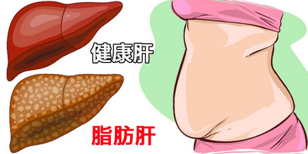 「脂肪肝」名列台灣國病！「逆轉脂肪肝」的4大食療絕招，護肝降脂不能等｜每日健康 Health