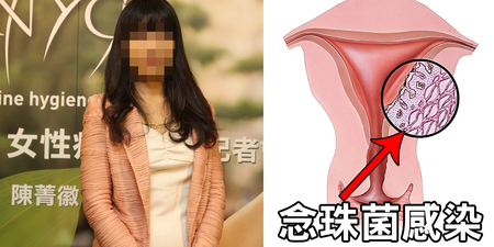 36歲女為塑身穿「三層褲」，私密處「嚴重惡臭」！ 「念珠菌感染」需注意的六件事｜每日健康 Health