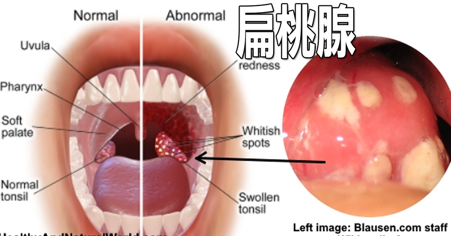 扁桃腺 反覆發炎看不好 多喝三種天然飲料 活化細胞遠離咽喉疼痛 每日健康health
