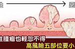 「腫瘤」不是惡性就沒關係？「良性」腫瘤長在【高風險五部位】要小心，別在體內種下癌症種子｜每日健康Health