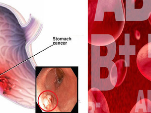血型也能決定「胃癌」風險！「三大癌前徵兆」別讓「胃潰瘍」與胃癌只有一線之隔｜每日健康Health