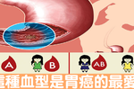 什麼！「血型」竟然決定「胃癌」機率？這種血型再加上「口臭」風險爆表｜每日健康