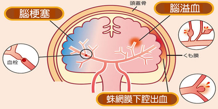 每天35人腦中風死亡！預防腦中風必做這五件事情｜每日健康 Health