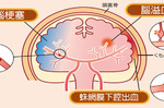 每天35人腦中風死亡！預防腦中風必做這五件事情｜每日健康 Health