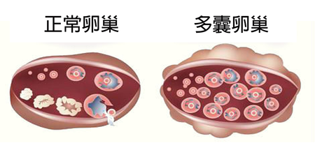 及早發現及早治療 → 調查顯示：「多囊卵巢」將會導致長期肥胖、月經紊亂、甚至不孕！