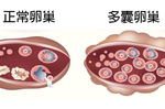 及早發現及早治療 → 調查顯示：「多囊卵巢」將會導致長期肥胖、月經紊亂、甚至不孕！