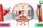 自己的生命自己救：視力受損、走路不穩、劇烈頭痛等「六大腦中風徵兆」任何一樣都不能放過！