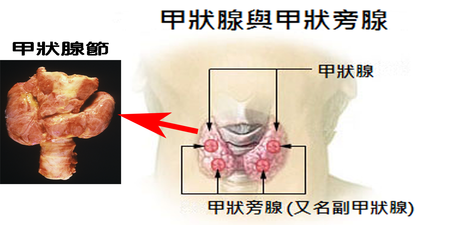 「脖子腫」還以為是扁桃腺發炎？是「甲狀腺節」惹的禍！注意5症狀以免「癌變」｜每日健康 Health