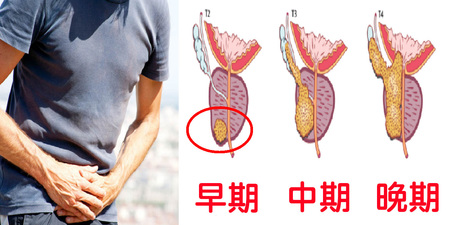 罹患率100%！「攝護腺」病變無痛感，當心腎衰竭、癌症悄悄上門，「4種男人」最需注意｜每日健康Health