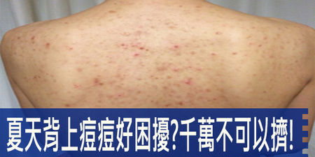 夏季又濕又熱，背部「痘痘」要怎麼對付呢？先別亂擠！消炎六種妙招報你知｜每日健康Health