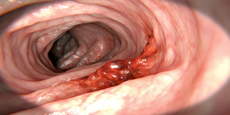 80%「大腸癌」跟家中病史沒關係！年輕的「4大惡習」才是主因！年過50就要注意別再犯｜每日健康Health