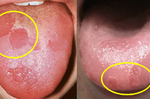 「7種舌頭」暗示身體百種病！舌上紅斑塊出現超過這時間，小心是口腔癌前兆！