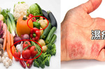 「濕疹」皮膚又紅又癢？快吃「除疹五蔬果」清熱、祛濕止癢，從此根絕反覆發作！｜每日健康Health