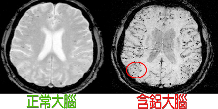 超危險！大腦「鋁殘留」竟是「阿茲海默症」元凶，快喝「除鋁救星」排除「致命毒素」｜每日健康 Health