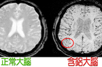 超危險！大腦「鋁殘留」竟是「阿茲海默症」元凶，快喝「除鋁救星」排除「致命毒素」｜每日健康 Health