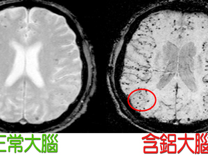 超危險！大腦「鋁殘留」竟是「阿茲海默症」元凶，快喝「除鋁救星」排除「致命毒素」｜每日健康 Health