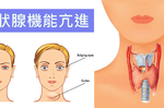 易緊張、凸眼、突然變瘦都是「甲狀腺亢進」之症狀，注意「四不做、兩吃」一同擊敗甲亢！