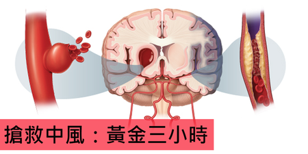 「九大症狀」預告中風即將來臨！多吃「顧腦兩寶」降膽固醇、血壓，想中風都難 ～