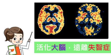 「阿茲海默症」是可以預防的：「腦部活化三運動」多走、多想、多睡，讓你的「腦齡」步步高！