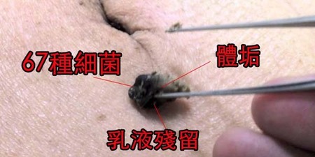 肚臍內含「67種細菌」等著攻擊！醫：遏止發黑飄惡臭，「凹凸」肚臍清潔兩者有別！