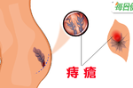 痔瘡沒藥醫？多吃消痔兩寶，修復傷口促便意｜每日健康 Health