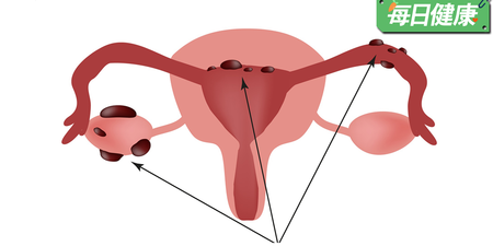 婦女病：子宮內膜異位名列前茅，五大症狀一秒看懂