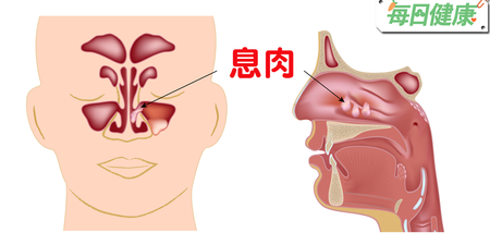 息肉不傳染靠遺傳！有大腸息肉症病史者，發生癌變的機率高達100%