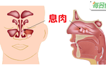 息肉不傳染靠遺傳！有大腸息肉症病史者，發生癌變的機率高達100%