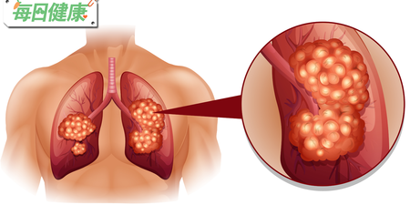 女性死因榜首竟是肺癌？烹飪方式改變，罹癌機率降50%｜每日健康 Health