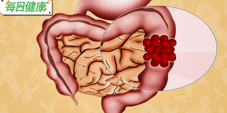 好發癌症第１名！即使不菸不酒，這三種人要特別小心｜每日健康