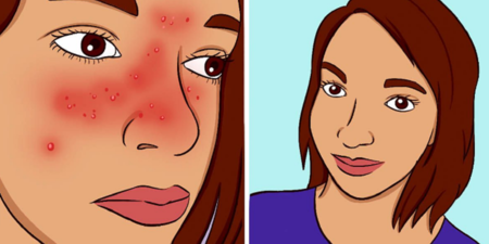 臉部總是發紅，長出像是粉刺的小凸起？小心是「酒糟性皮膚炎」！這些症狀你不能不知道。