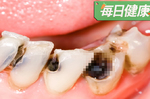 台灣竟是蛀牙王國！再不這樣顧牙齒就爛光光啦｜每日健康 Health