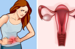 「卵巢囊腫」其實很多女性都有！這些警訊必須注意，否則卵巢毀了，下半生也毀了。