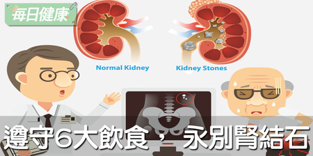 腎結石竟分三種！醫生一秒破解石頭密碼，病原不同治療差很大｜每日健康 Health