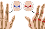 女性好發類風濕性關節炎機率高３倍！學會這6招，緩解病症超有效｜每日健康Health