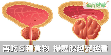 小心下半身！男人這5種食物吃多了，不只攝護腺越變越腫，還會引發癌變！｜每日健康 Health