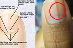 「指甲」上的「黑線」竟是腫瘤前兆？「7大指甲癥狀」攸關自體免疫系統，不可不知。