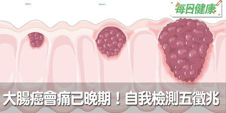 貧血、變瘦、水腫？大腸癌不為人知的險惡徵兆，醫生警告：拉出這種形狀大便最危險｜每日健康 Health