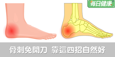骨刺免開刀！4招居家療法迅速消炎，天天做骨刺自然好｜每日健康 Health